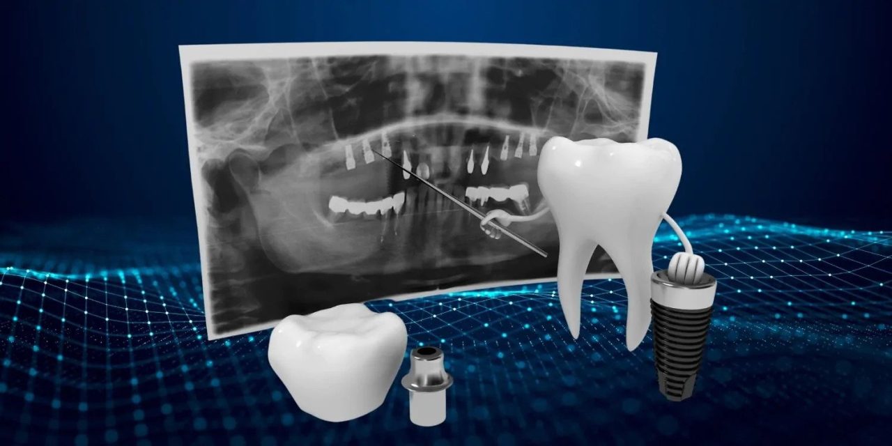 رادیولوژی ایمپلنت دندان - دیجینوی
