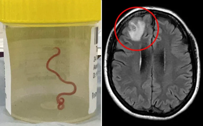 Jar containing a pale liquid with a red, coiled parasitic worm inside. Left image shows specimen container with worm. Right image: axial brain MRI with a circled lesion in the left parietal region.